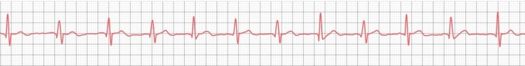 Die iHEAL 6 bewertet das EKG nicht nur, sondern kann dieses grafisch ausgeben