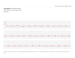 Als Vergleich ein EKG der Apple Watch...